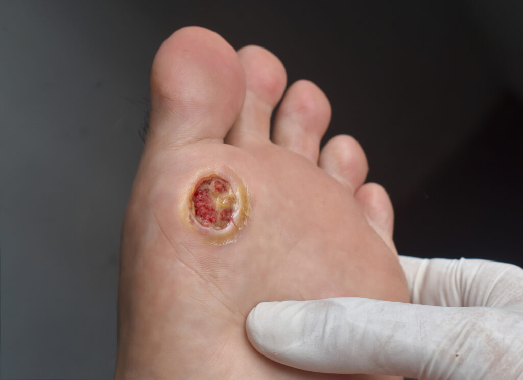 Infections Caused by Resistant Bacteria Complicate Treatment of Diabetic Foot Ulcers